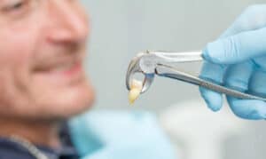 tooth extraction