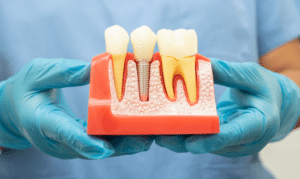 The Power of Dental Implants- Your Ultimate Tooth Replacement Solution
