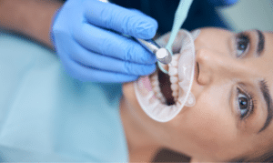 Signs You Might Need a Dental Filling- What to Look Out For