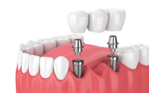 Why Fixed Bridges Matter In Restorative Dentistry