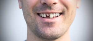 emergency dentist for knocked out tooth